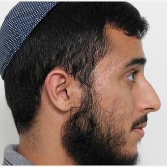 18-24 year old man treated with Rhinoplasty before 3448594