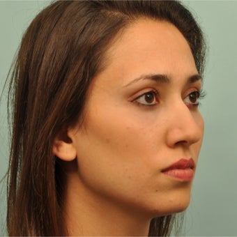 25-34 year old woman treated with Restylane after 2203406
