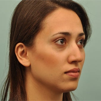 25-34 year old woman treated with Restylane before 2203406