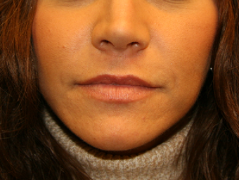 Lip lift after 606749