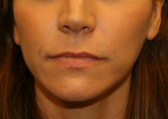 Lip lift before 606749