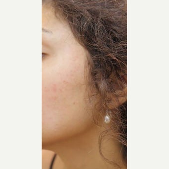 Acne Scars treated with ProFractional Laser after 1918884