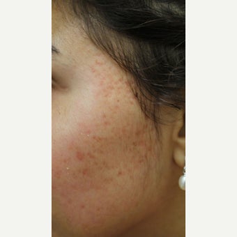 Acne Scars treated with ProFractional Laser before 1918884