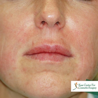 Lip augmentation after 340185