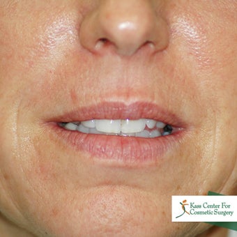 Lip augmentation before 340185