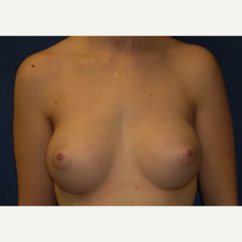 18-24 year old woman treated with Breast Augmentation after 3220069