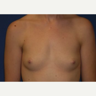 18-24 year old woman treated with Breast Augmentation before 3220069