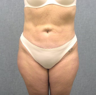 SmartLipo after 607515