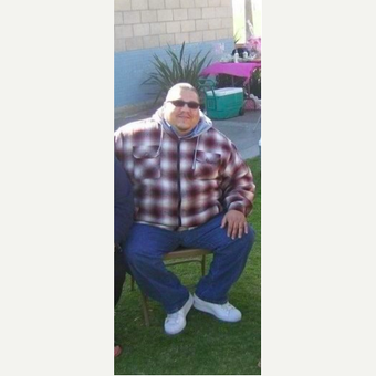 Bariatric Surgery: Sleeve Gastrectomy (Gastric Sleeve) before 2692631