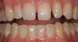 A Forty Three Year Old Female Treated with Porcelain Veneers before 1027945