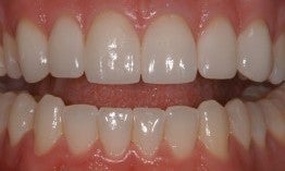 A Forty Three Year Old Female Treated with Porcelain Veneers after 1027945