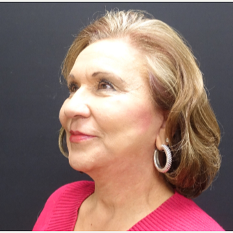 65-74 year old woman treated with SMAS Facelift after 3244965