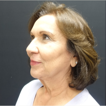 65-74 year old woman treated with SMAS Facelift before 3244965