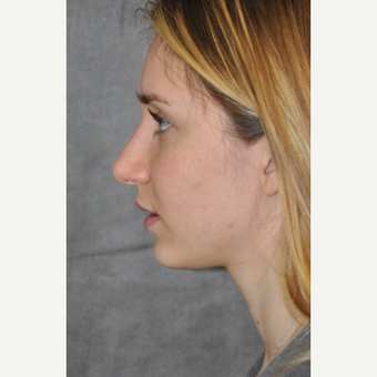 25-34 year old woman treated with Rhinoplasty after 3566083