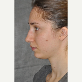 25-34 year old woman treated with Rhinoplasty before 3566083