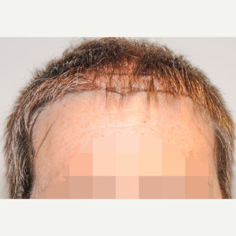 45-54 year old man treated with FUSS Hair Transplant before 3327153