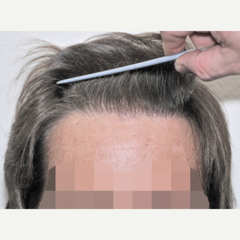 45-54 year old man treated with FUSS Hair Transplant after 3327153