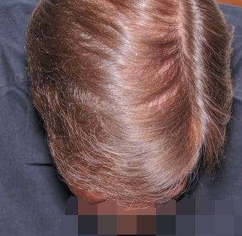 45-54 year old man treated with FUSS Hair Transplant 3327153