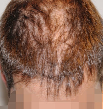 45-54 year old man treated with FUSS Hair Transplant 3327153