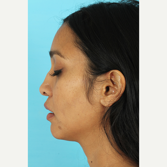 25-34 year old woman treated with Revision Rhinoplasty before 3691235