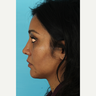 25-34 year old woman treated with Revision Rhinoplasty after 3691235