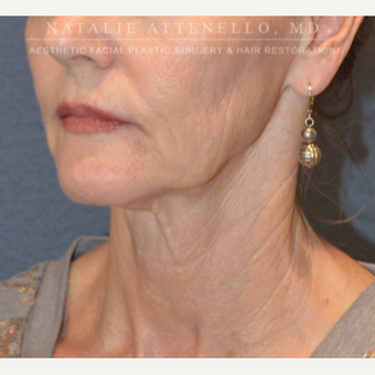 Before and After a Facelift before 3613838
