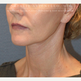 Before and After a Facelift after 3613838