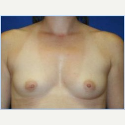 27 year old woman with breast asymmetry- breast augmentation before 3310697