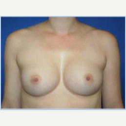 27 year old woman with breast asymmetry- breast augmentation after 3310697