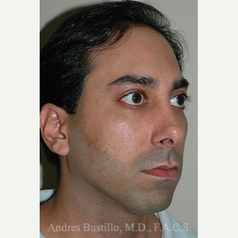 31 year old man treated with Revision Rhinoplasty before 3460721