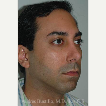 31 year old man treated with Revision Rhinoplasty after 3460721