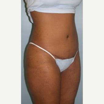 35-44 year old man treated with Tummy Tuck 1848314