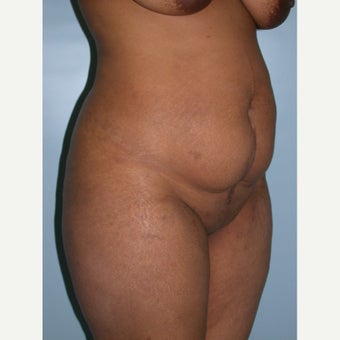 35-44 year old man treated with Tummy Tuck 1848314