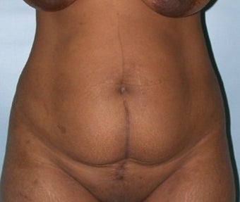 35-44 year old man treated with Tummy Tuck before 1848314