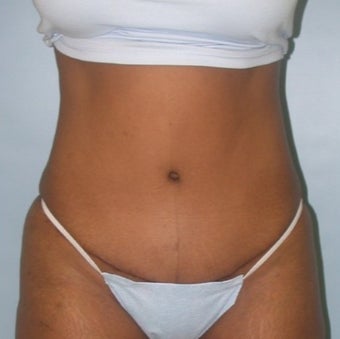35-44 year old man treated with Tummy Tuck after 1848314