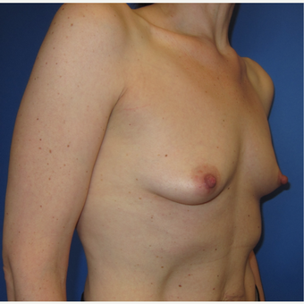 45-54 year old woman treated with Breast Augmentation (R. 286cc, L. 304cc) before 3309890