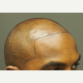 25-34 year old man treated with Scalp Micropigmentation before 2447039