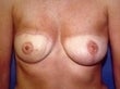 36 year old female patient after 934514