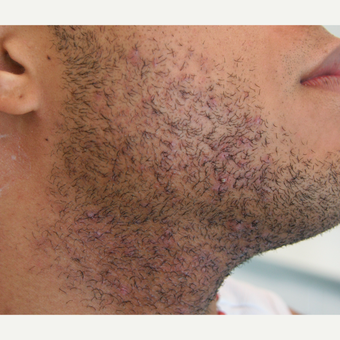 25-34 year old man treated with Laser Hair Removal before 3320319