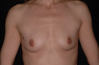 42 Year Old Female With Sientra Classic Shaped Breast Implants before 1192276