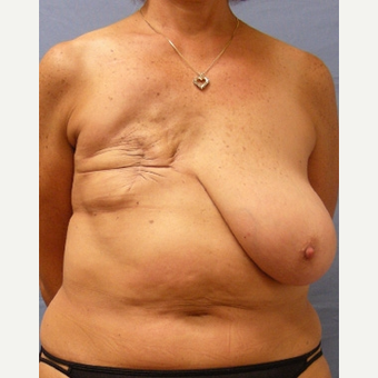 55-64 year old woman treated with Breast Reconstruction before 3630818