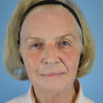 75 and up year old woman treated with ArteFill after 2285599