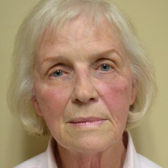 75 and up year old woman treated with ArteFill before 2285599