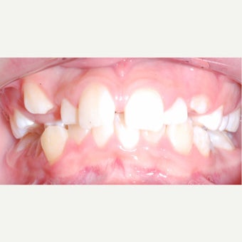 17 or under year old woman treated with Braces before 2244697