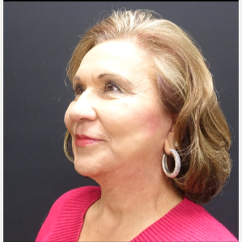 65-74 year old woman treated with Lower Face Lift after 3244881
