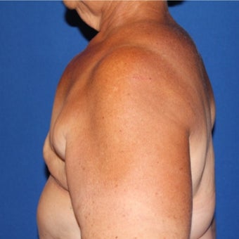 65-74 year old woman treated with Breast Reconstruction before 1984891