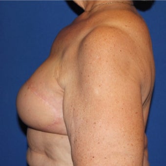 65-74 year old woman treated with Breast Reconstruction after 1984891