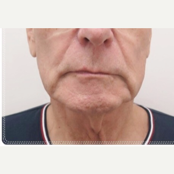 65-74 year old man treated with Neck Lift before 3649098