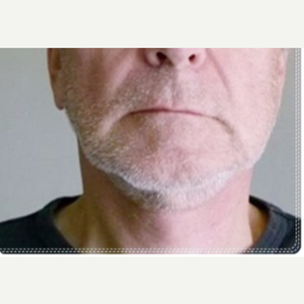 65-74 year old man treated with Neck Lift after 3649098