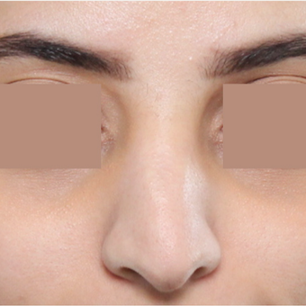 25-34 year old woman treated with Rhinoplasty before 3565682